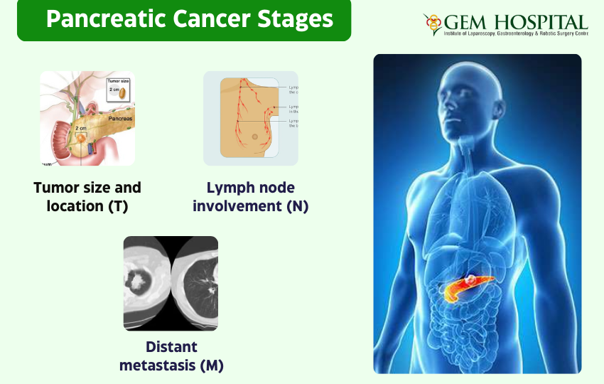 Pancreatic Cancer Treatment In Coimbatore GEM Hospitals pancreatic-cancer-treatment-in-coimbatore-gem-hospitals