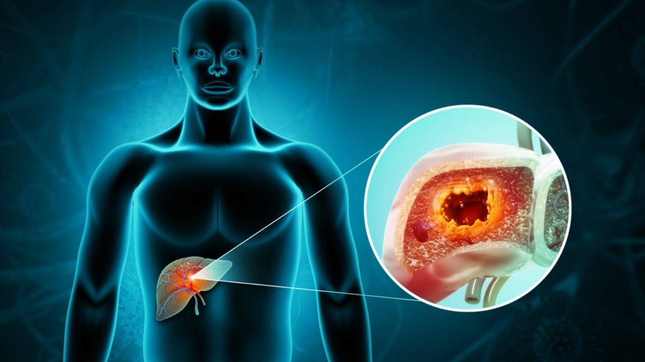 hepatocellular-jaundice