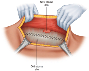 open-hernia-repair-treatment-feature