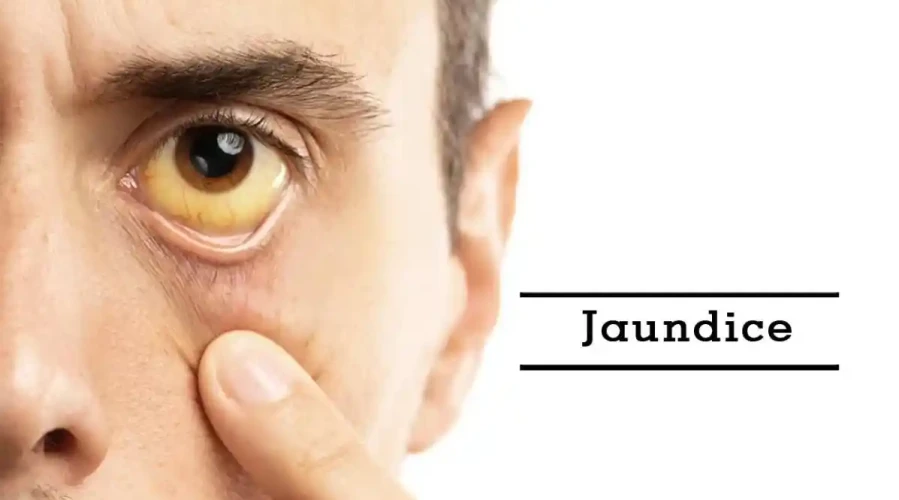 Signs of Jaundice: What You Need to Know