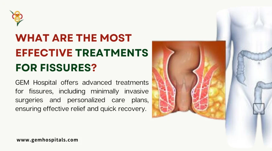 What Are the Most Effective Treatments for Fissures