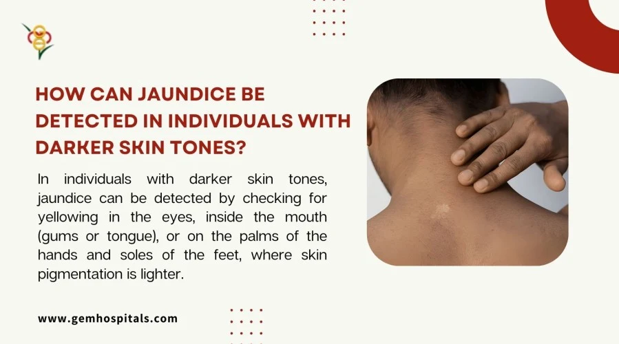 How can jaundice be detected in individuals with darker skin tones?