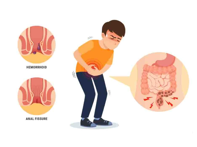 Fistula Care