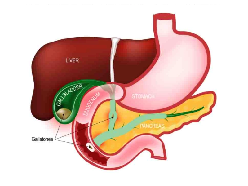 Gallbladder Stones