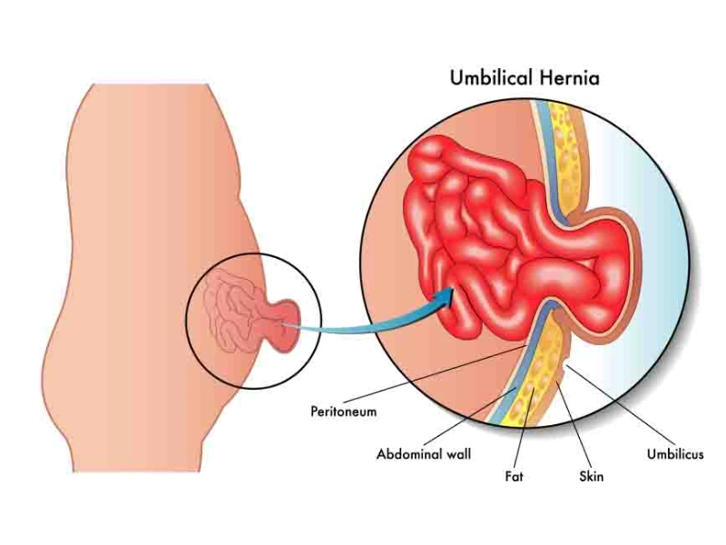 Hernia Treatment