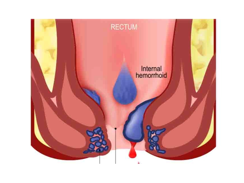 Piles Treatment