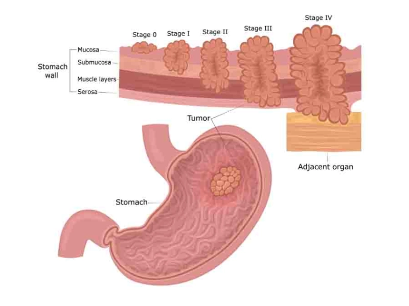 Stomach Cancer